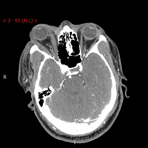 Caroticocavernous fistula (Radiopaedia 42346-45457 B 24).jpg