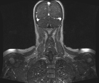 Carotid body tumor (Radiopaedia 12777-12912 MRA 64).jpg