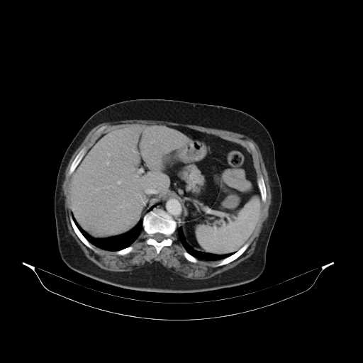 File:Carotid body tumor (Radiopaedia 21021-20948 B 62).jpg