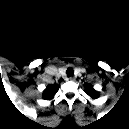 File:Carotid body tumor (Radiopaedia 27890-28124 A 27).jpg