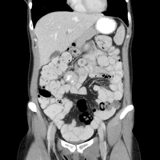 File:Castleman disease with fibrous pseudotumor in the abdomen (Radiopaedia 77296-89373 B 31).jpg