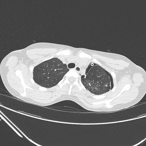 File:Catamenial pneumothorax (Radiopaedia 27946-28197 lung window 39).jpg