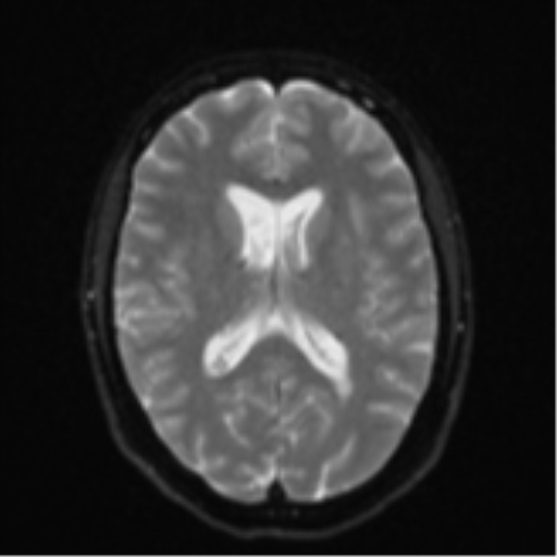 File:Cavernoma with bleed - midbrain (Radiopaedia 54546-60774 Axial DWI 15).png