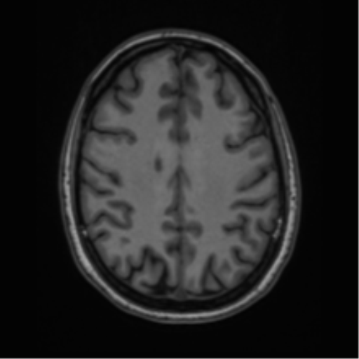 Cavernoma with bleed - midbrain (Radiopaedia 54546-60774 Axial T1 36).png