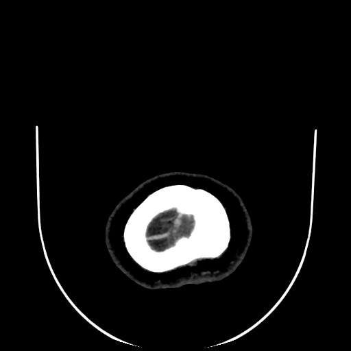 Cavernoma with developmental venous anomaly (Radiopaedia 22470-22506 C 202).jpg