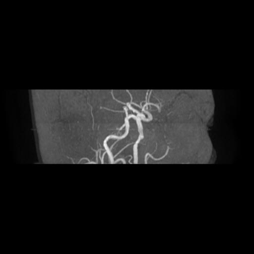 File:Cavernoma with developmental venous anomaly (Radiopaedia 22470-22507 MRA 16).jpg