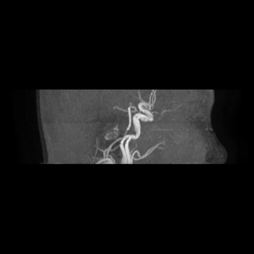 Cavernoma with developmental venous anomaly (Radiopaedia 22470-22507 MRA 19).jpg