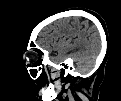 Cavernous hemangioma of the cerebellar falx (Radiopaedia 73025-83723 B 244).jpg
