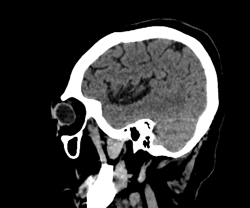 Cavernous hemangioma of the cerebellar falx (Radiopaedia 73025-83723 B 75).jpg