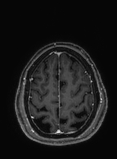 Cavernous hemangioma of the cerebellar falx (Radiopaedia 73025-83724 Axial T1 C+ 67).jpg