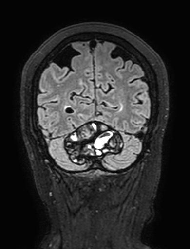 Cavernous hemangioma of the cerebellar falx (Radiopaedia 73025-83724 Coronal FLAIR 291).jpg
