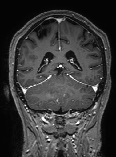 Cavernous hemangioma of the cerebellar falx (Radiopaedia 73025-83724 Coronal T1 C+ 260).jpg