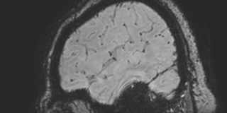 Cavernous hemangioma of the cerebellar falx (Radiopaedia 73025-83724 Sagittal BOLD 31).jpg