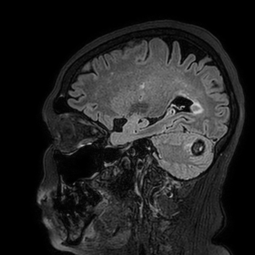 Cavernous hemangioma of the cerebellar falx (Radiopaedia 73025-83724 Sagittal FLAIR 65).jpg