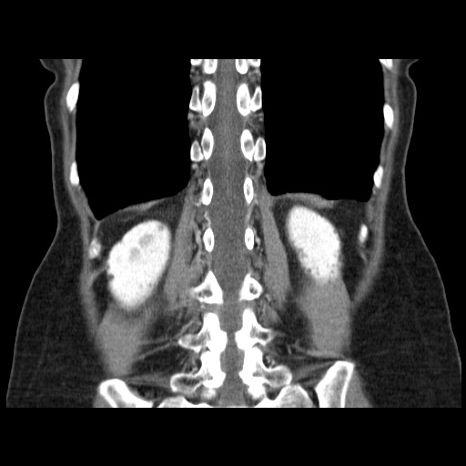 Cavernous hepatic hemangioma (Radiopaedia 75441-86667 C 114).jpg