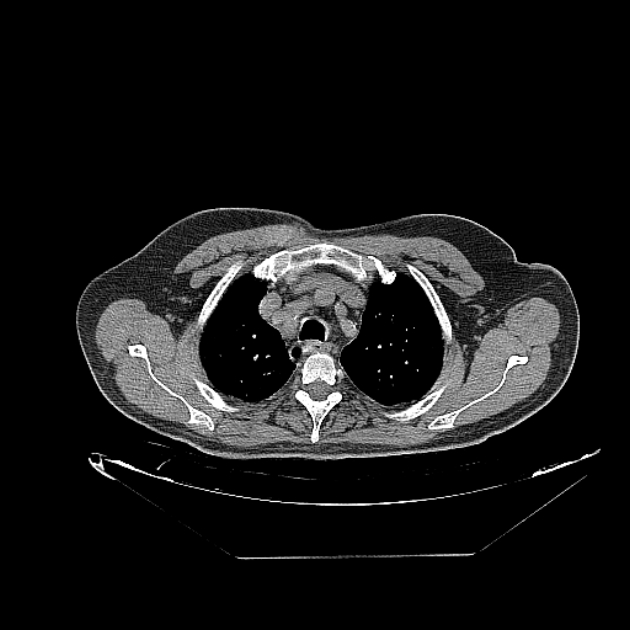Cavitating bronchogenic carcinoma (Radiopaedia 44489-48162 Axial non-contrast 13).jpg
