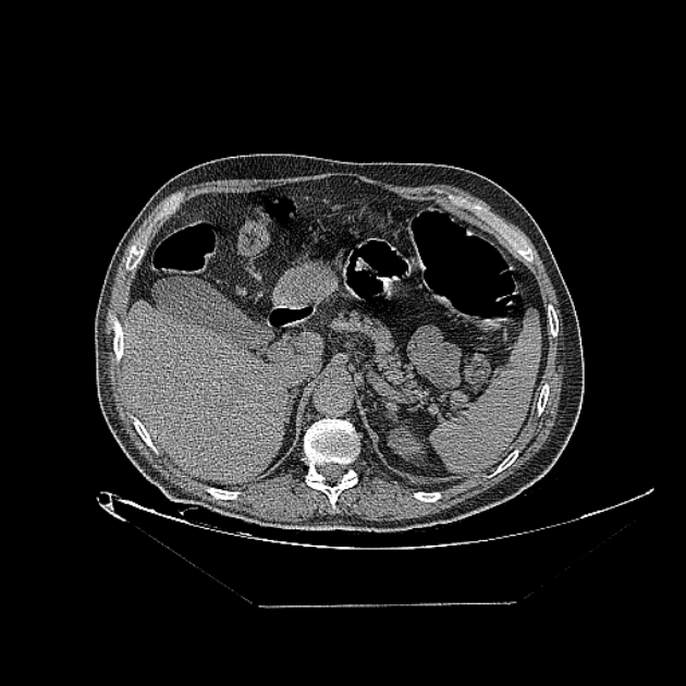 Cavitating bronchogenic carcinoma (Radiopaedia 44489-48162 Axial non-contrast 88).jpg
