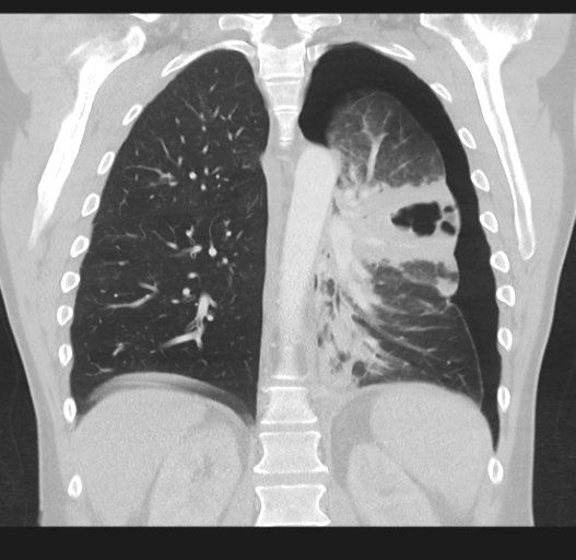Cavitating pneumonia complicated by pneumothorax (Radiopaedia 48149-52994 Coronal lung window 39).png