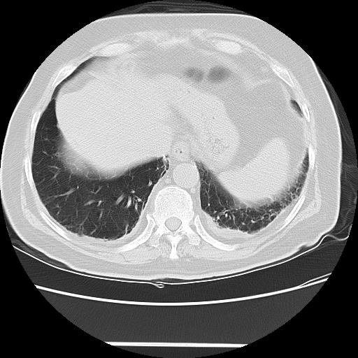 Cavitating pulmonary metastases (Radiopaedia 89545-106544 Axial lung window 46).jpg