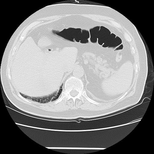 Cavitating pulmonary metastases (Radiopaedia 89545-106544 Axial lung window 54).jpg