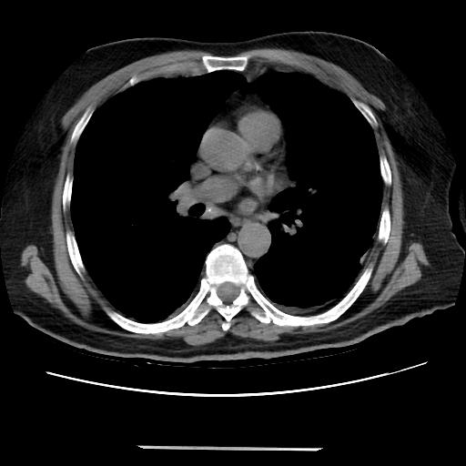 Cavitating pulmonary metastases (Radiopaedia 89545-106544 Axial non-contrast 29).jpg