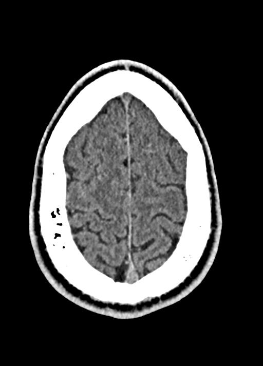 Cavum septum pellucidum and cavum vergae (Radiopaedia 77797-90060 Axial Brain Window 89).jpg