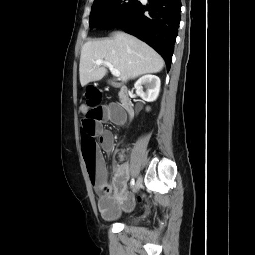 Cecal adenocarcinoma (Radiopaedia 75909-87331 C 29).jpg