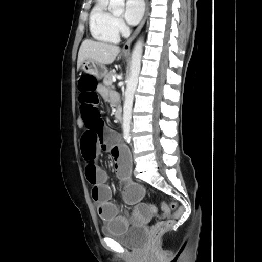 Cecal adenocarcinoma (Radiopaedia 75909-87331 C 39).jpg