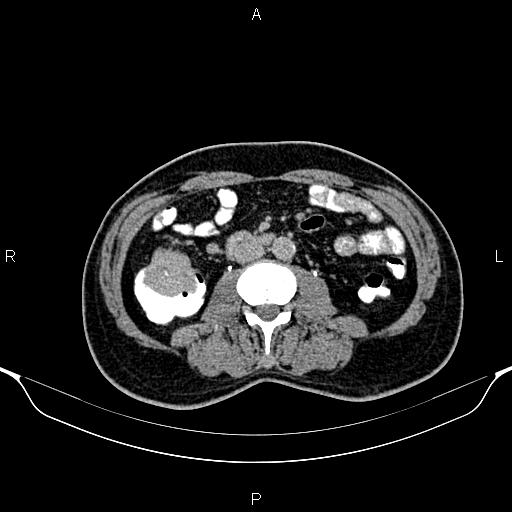 Cecal adenocarcinoma (Radiopaedia 85324-100916 Axial C+ delayed 50).jpg