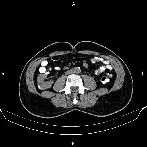 Cecal adenocarcinoma (Radiopaedia 85324-100916 Axial non-contrast 54).jpg