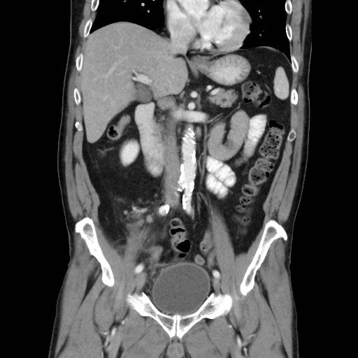 Cecal mass causing appendicitis (Radiopaedia 59207-66531 B 25).jpg