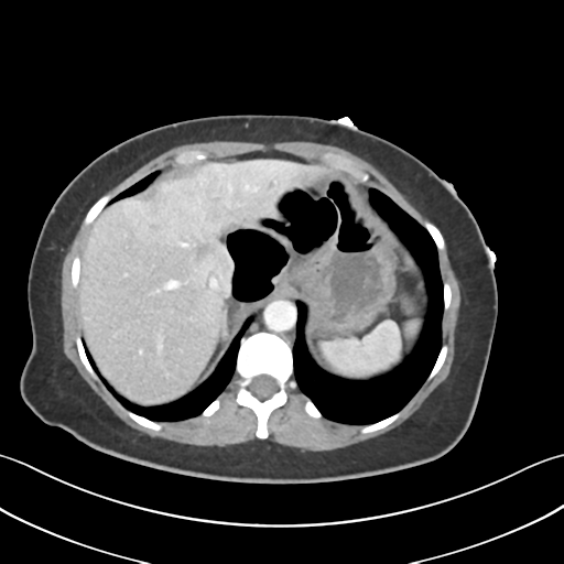 Cecum hernia through the foramen of Winslow (Radiopaedia 46634-51112 A 14).png