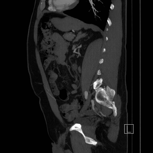 File:Celiac artery compression by the diaphragmatic crurae (Radiopaedia 31739-32666 C 1).jpg