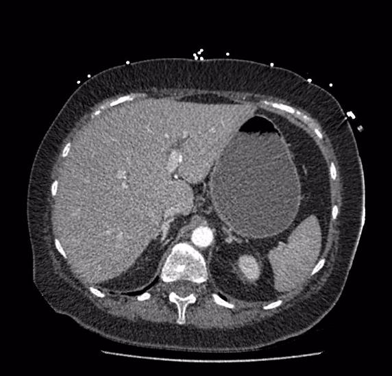 Celiac artery severe stenosis and dissection (Radiopaedia 44128-47842 B 18).jpg