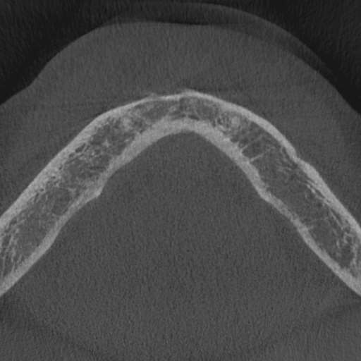 Cemento-osseous dysplasia (Radiopaedia 48251-53126 Axial non-contrast 13).jpg