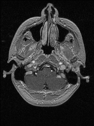 Central neurocytoma (Radiopaedia 56690-63469 Axial T1 C+ 25).jpg