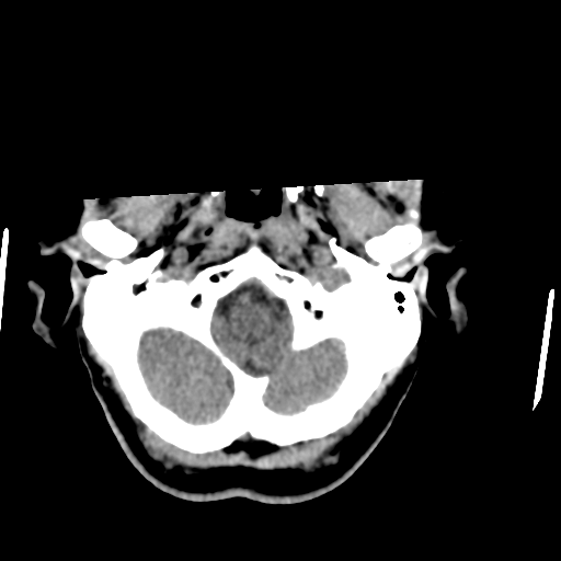 File:Central neurocytoma (Radiopaedia 65317-74346 Axial non-contrast 7).png