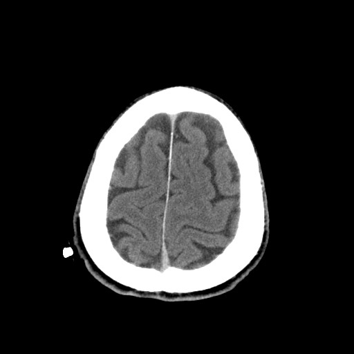 Central neurocytoma (Radiopaedia 68725-78432 Axial C+ 83).jpg