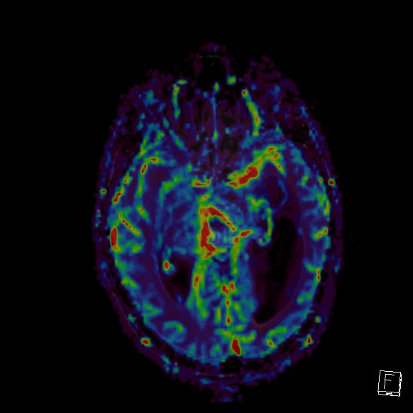 Central neurocytoma (Radiopaedia 84497-99872 Axial Perfusion 183).jpg