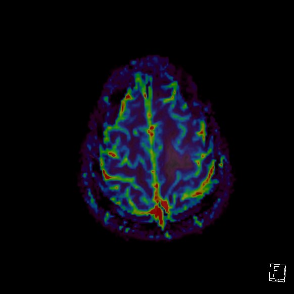 Central neurocytoma (Radiopaedia 84497-99872 Axial Perfusion 42).jpg