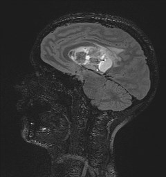 File:Central neurocytoma (Radiopaedia 84497-99872 Sagittal Flair + Gd 71).jpg