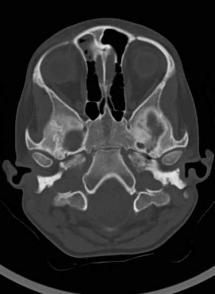 Cerebellar abscess (Radiopaedia 73727-84527 Axial bone window 21).jpg
