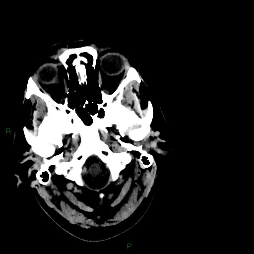 Cerebellar abscess (Radiopaedia 78135-90671 Axial C+ delayed 11).jpg