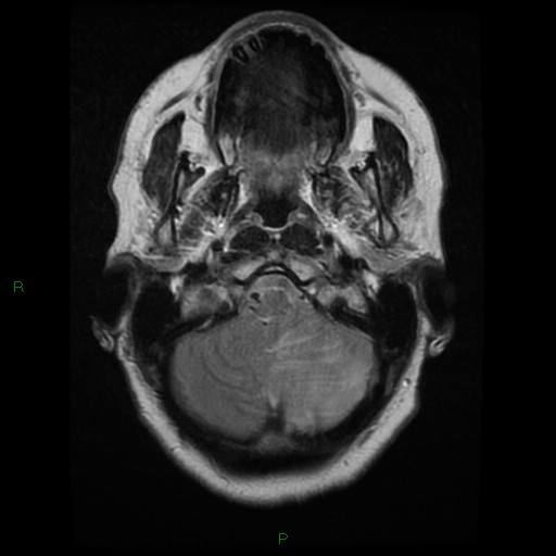 File:Cerebellar abscess (Radiopaedia 78135-90678 Axial T2 5).jpg