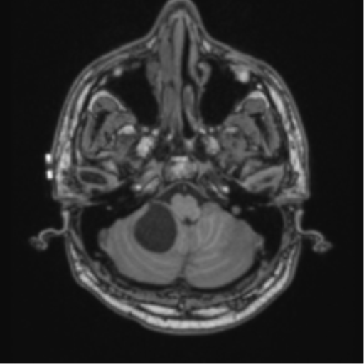 Cerebellar hemangioblastomas and pituitary adenoma (Radiopaedia 85490-101176 Axial T1 14).png