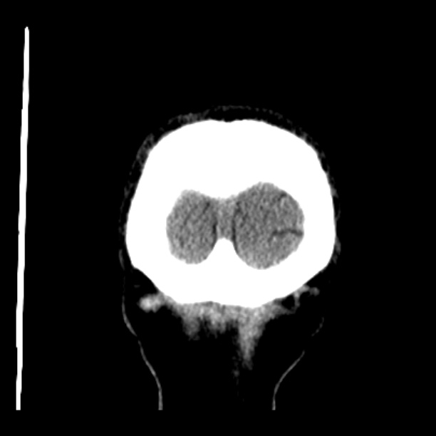 Cerebellar hemorrhage (Radiopaedia 27193-27359 Coronal non-contrast 55).jpg