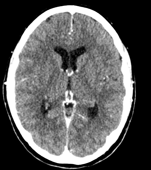 Cerebellar metastases - colorectal adenocarcinoma (Radiopaedia 40947-43652 Axial C+ 30).png