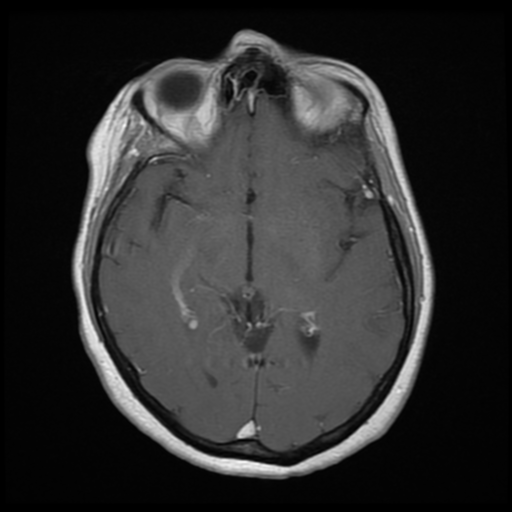 File:Cerebellar metastasis (cystic appearance) (Radiopaedia 41395-44268 Axial T1 C+ 11).png