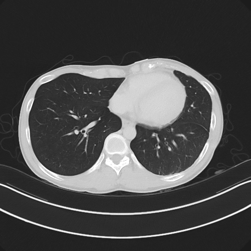 Cerebellar metastasis - adenocarcinoma lung (Radiopaedia 63184-71717 Axial lung window 47).png