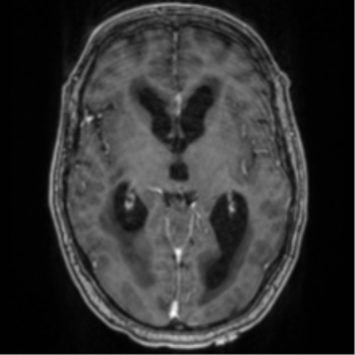 Cerebellar metastasis from lung adenocarcinoma (Radiopaedia 86690-102829 Axial T1 C+ 40).png